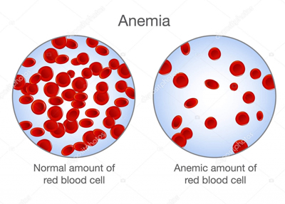 Anemia