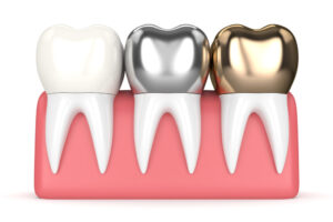 Importance of Dental Fillings or Dental Restoration