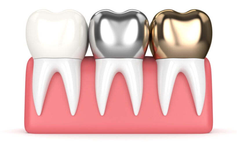 Importance of Dental Fillings or Dental Restoration