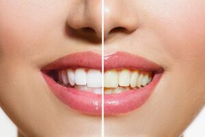 Teeth staining benefits