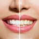 Teeth staining benefits