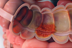 Ulcerative Colitis