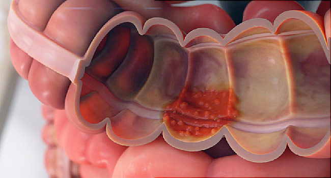 Ulcerative Colitis