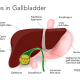 Gallstone in Gallbladder