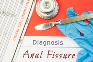 Anal fissure